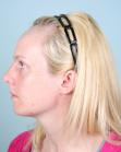 Before Hair Transplant&nbsp;Hairline